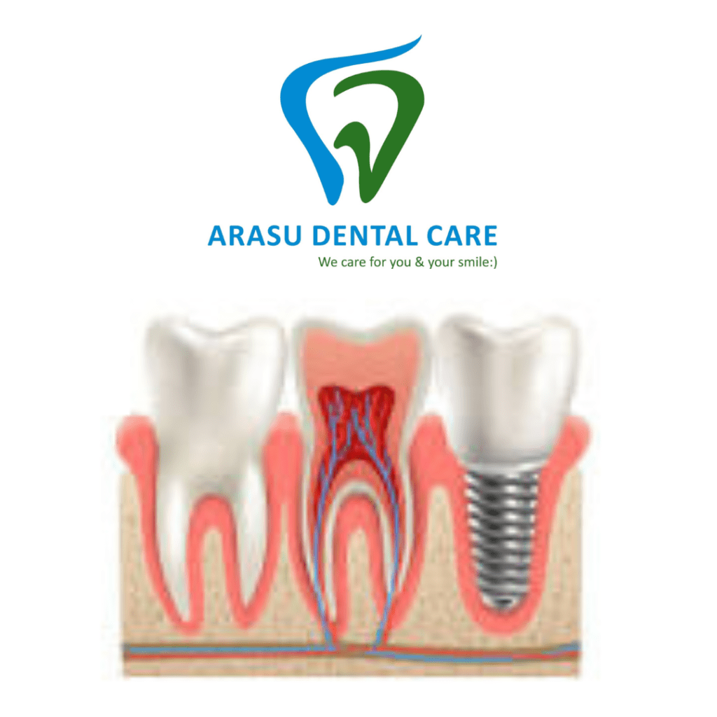 Best Dental Implant Clinic in Coimbatore