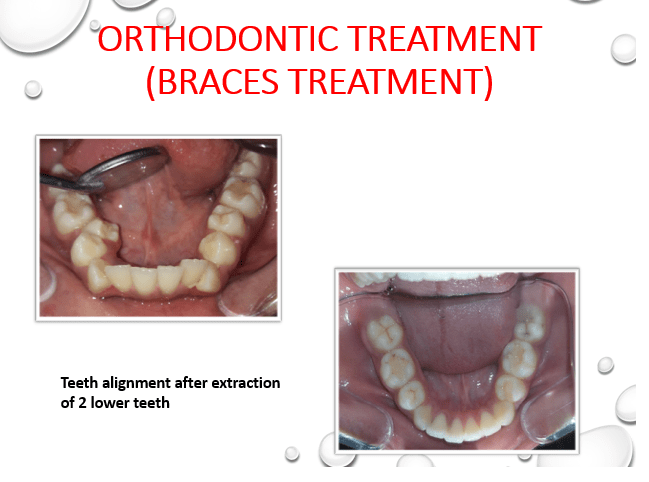 Low Jaw Orthodontic Treatment