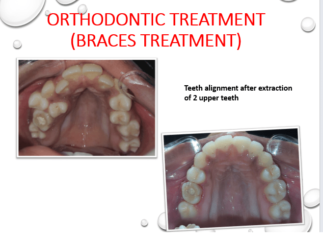 Upper Jaw Orthodontic treatment