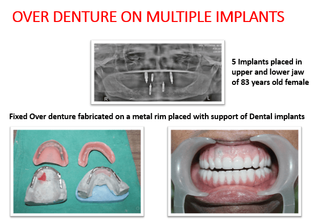 Dental Implant over Denture