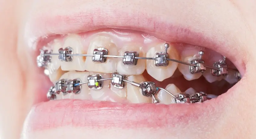 Self ligating [DAMON] metal braces treatment at coimbatore