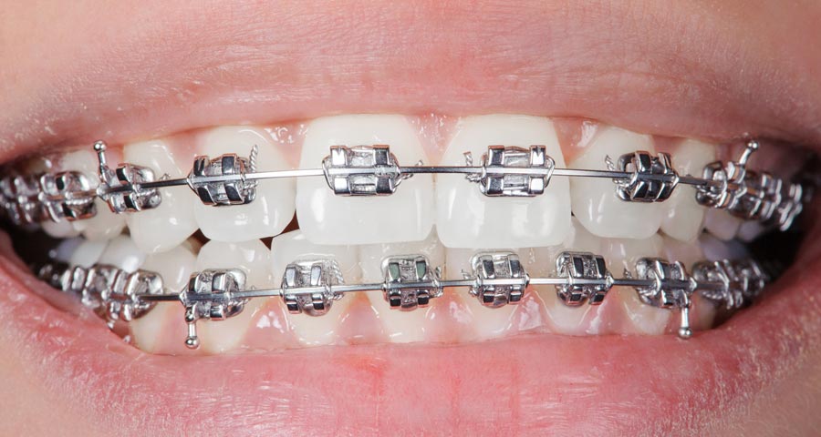 Metal braces treatment at coimbatore