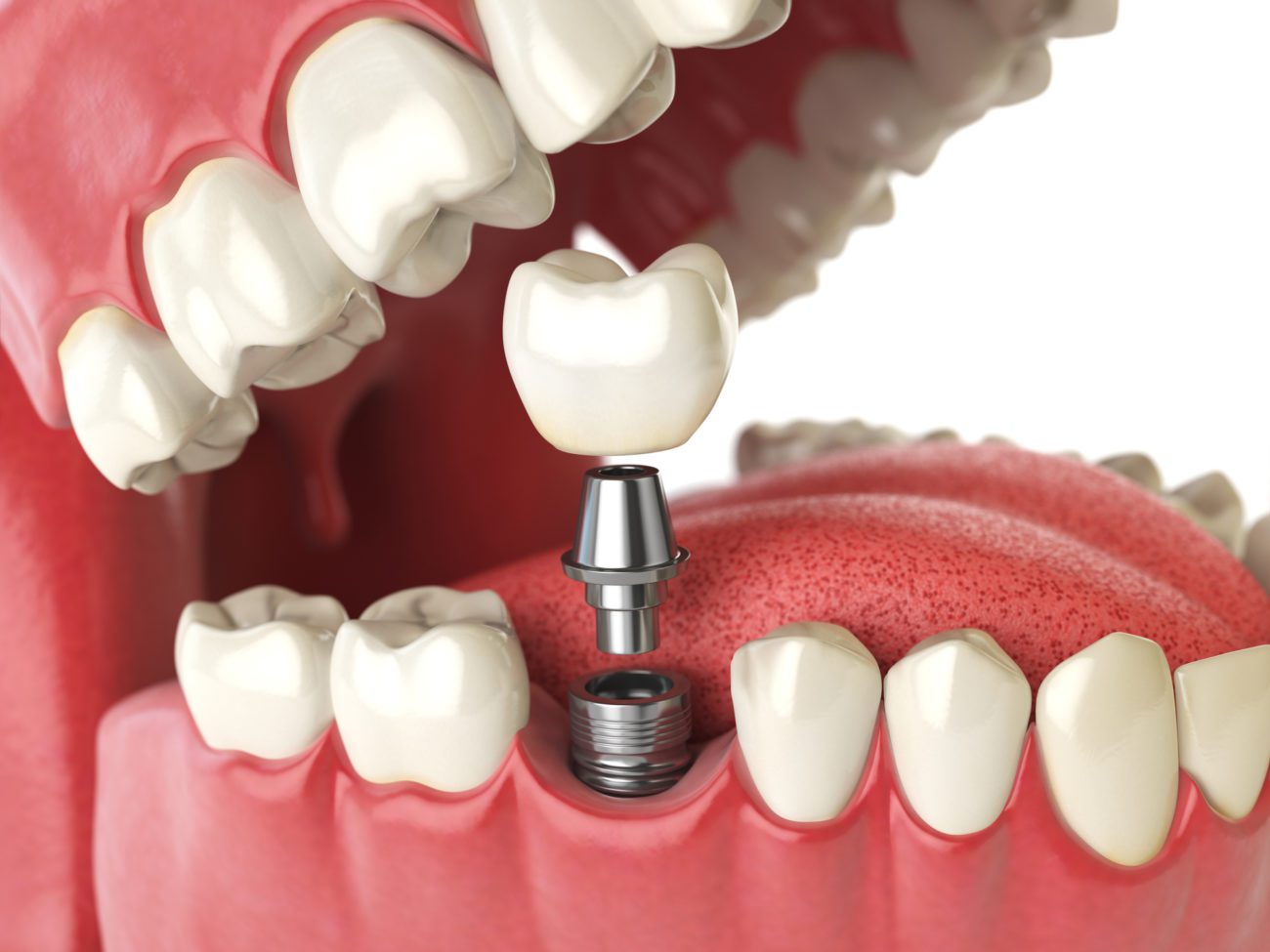 Best Dental Implant Clinic in Coimbatore