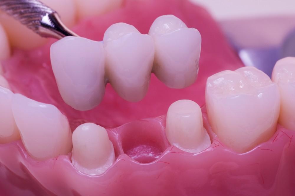 dental bridges back teeth in coimbatore