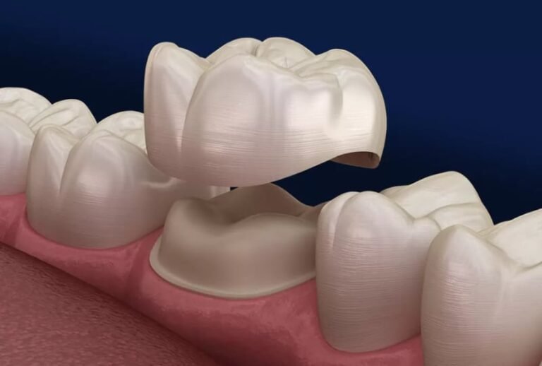 Dental Crowns and Bridges in Coimbatore
