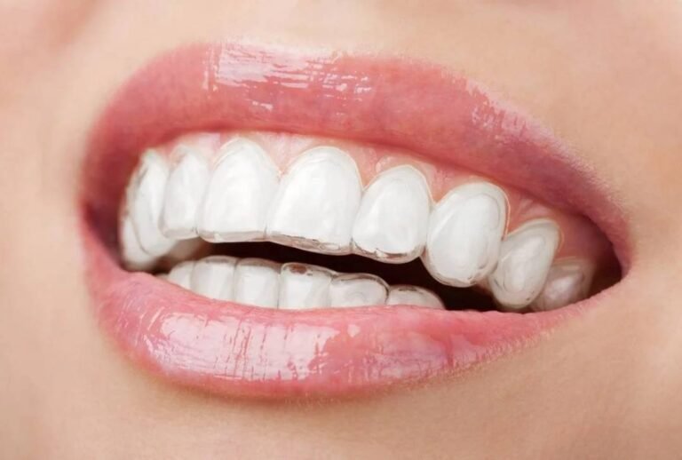 Invisalign Teeth Braces Cost in Coimbatore