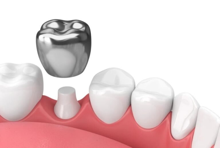Tooth Cap Cost in Coimbatore