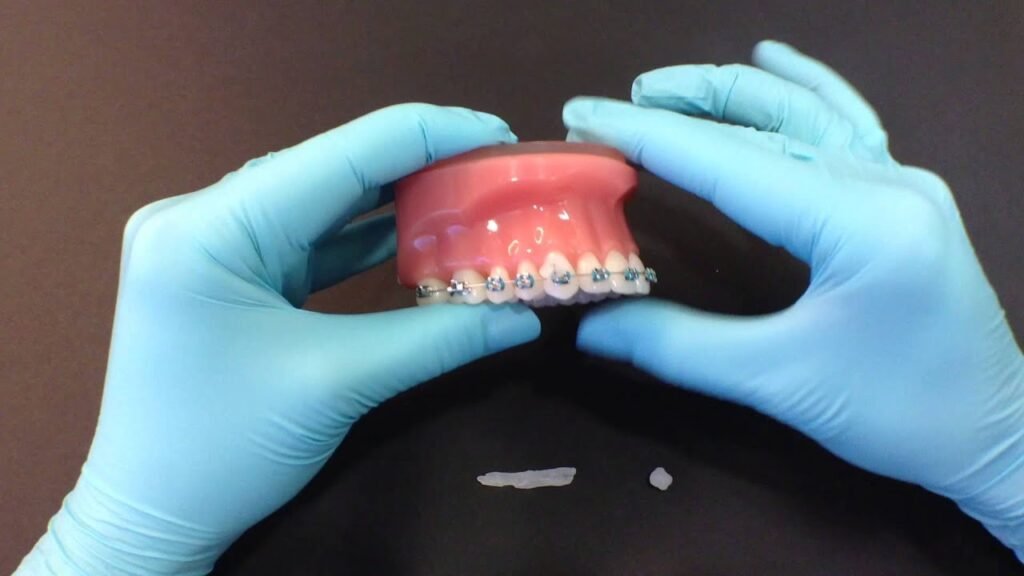 Orthodontic Wax: The Complete Guide to Protecting Your Braces (With Expert Tips)
