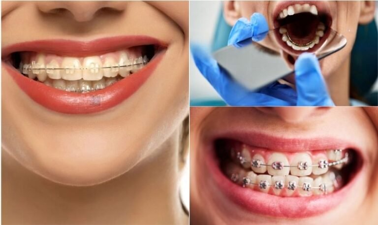 Types of Braces: Your Complete Guide to Dental Options