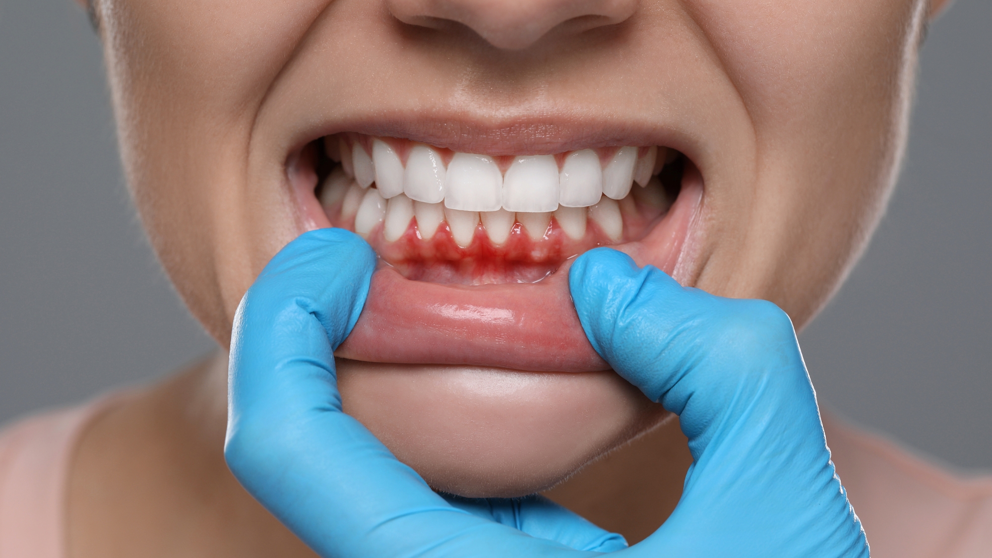 Gum Contouring for a Perfect and Healthy Smile