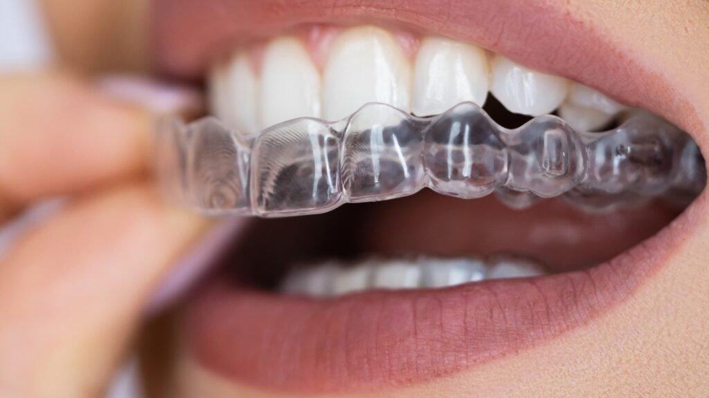 Invisible retainers :Cost and Procedure