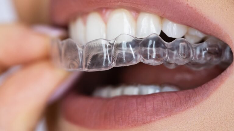 Invisible retainers :Cost and Procedure