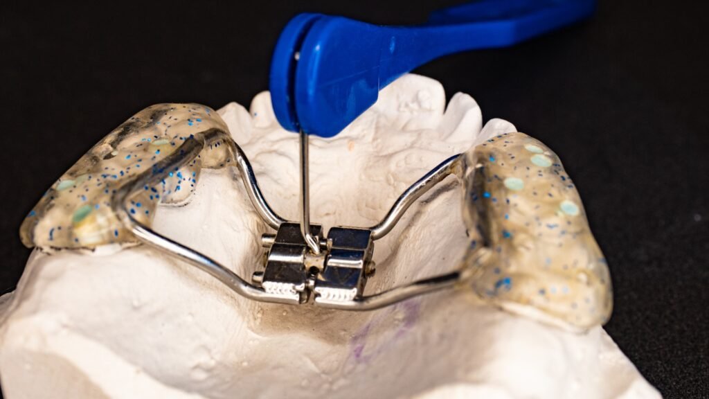 What are Palatal Expanders : A Complete Overview