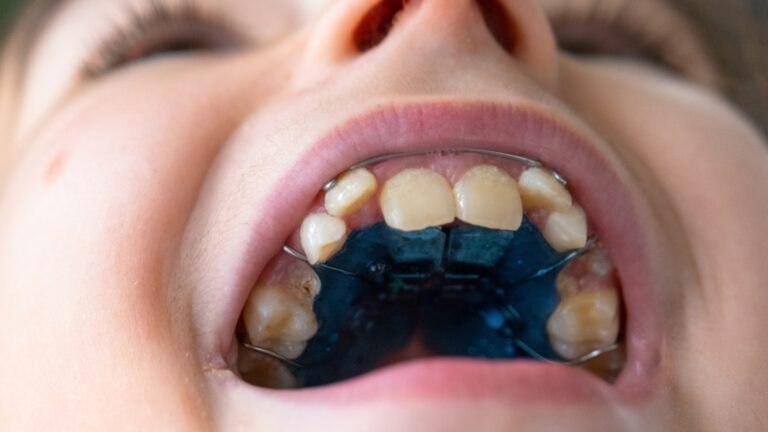 What Happens During a Palatal Expander Treatment?