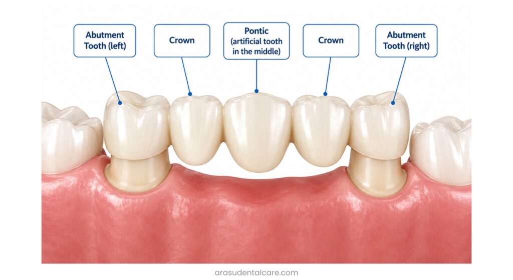 parts of a porcelain dental bridge