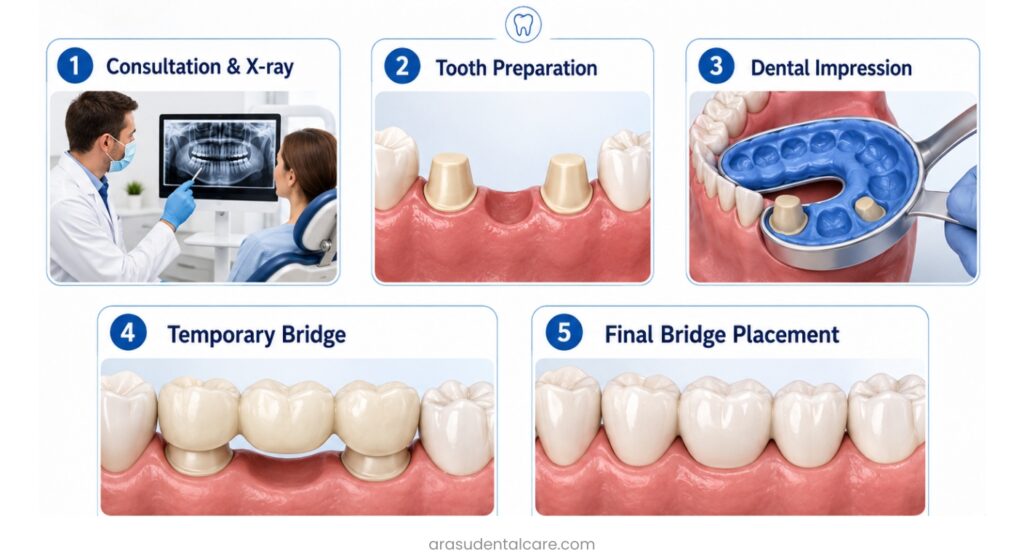 Porcelain Dental Bridge Treatment Process