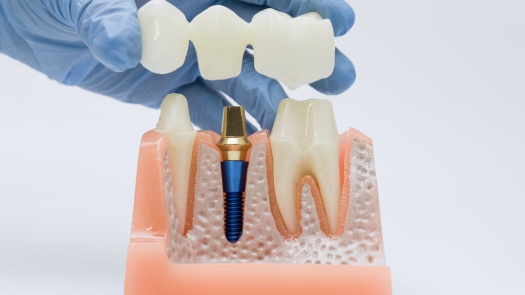 Advantages of Zirconia Crowns and Their Cost