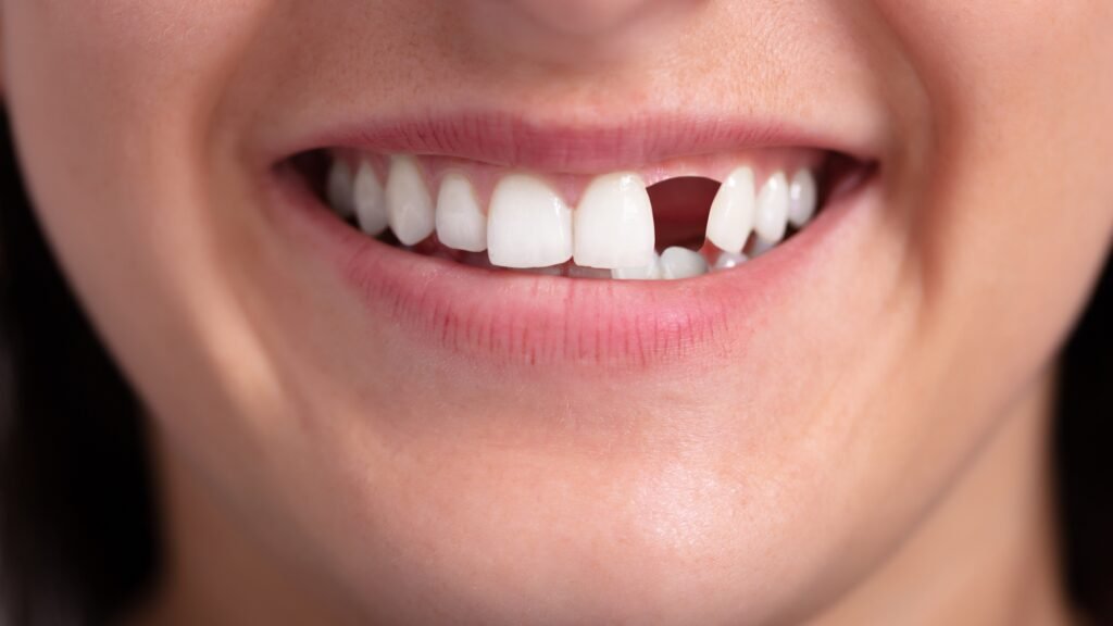 Dental Bridge for missing teeth : Advantages and Cost