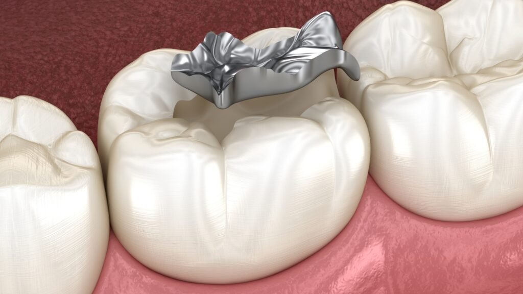 How is silver filling done? Step by step procedure