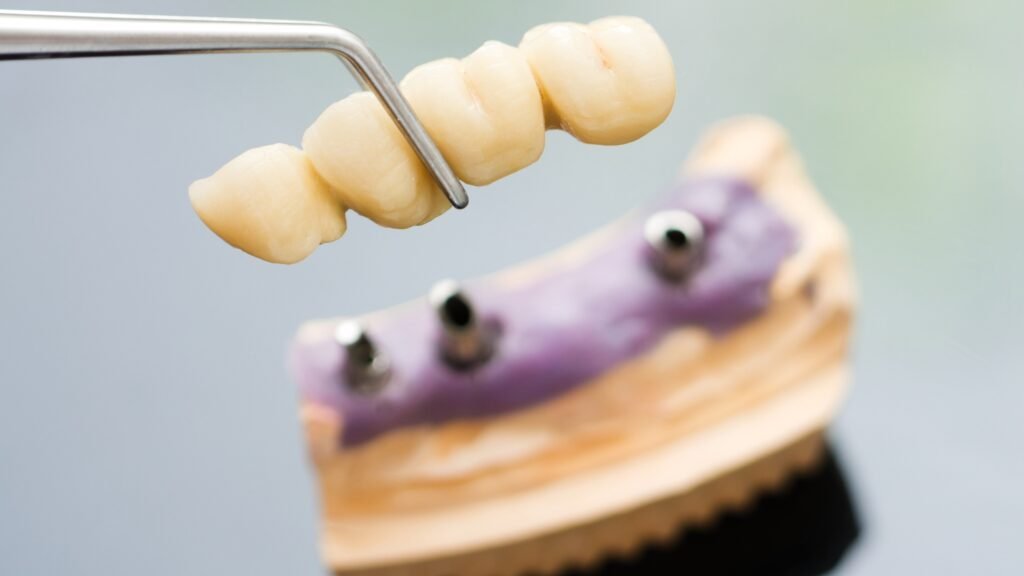 Removable Dental Bridge Treatment : Procedure and Benefits