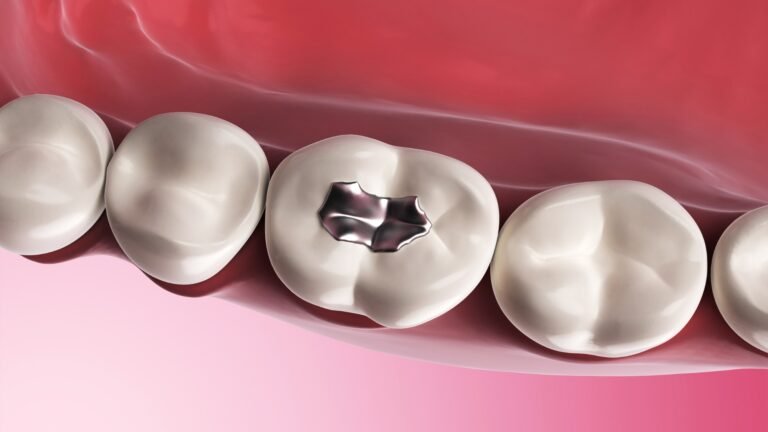 Silver filling in dentistry : Procedure & Cost