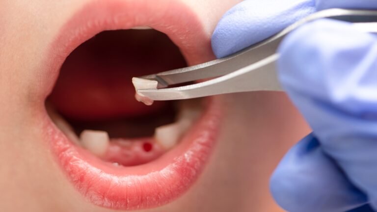 What Happens During a Simple Tooth Extraction?