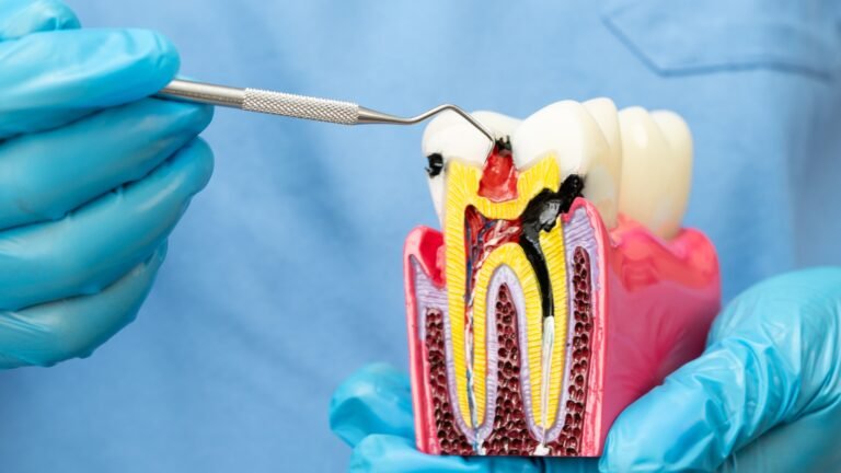 What is root end surgery? Treatment and Cost