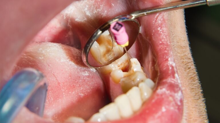 Who Needs a Tooth-Colored Composite Filling?