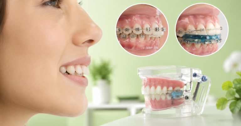 Overbite Correction Treatment: Options & Results