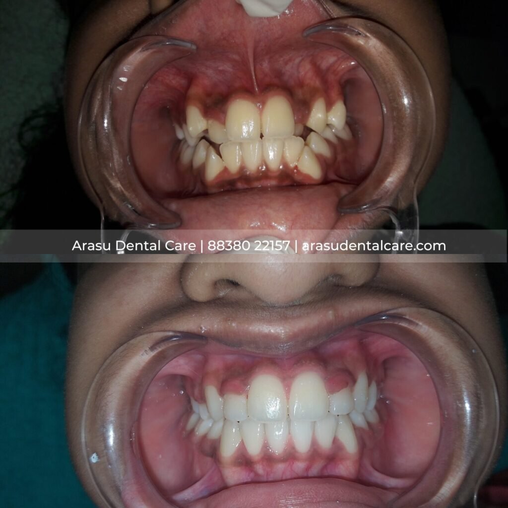 Before and after — crowded front teeth aligned with clear aligners at Arasu Dental Care, Coimbatore