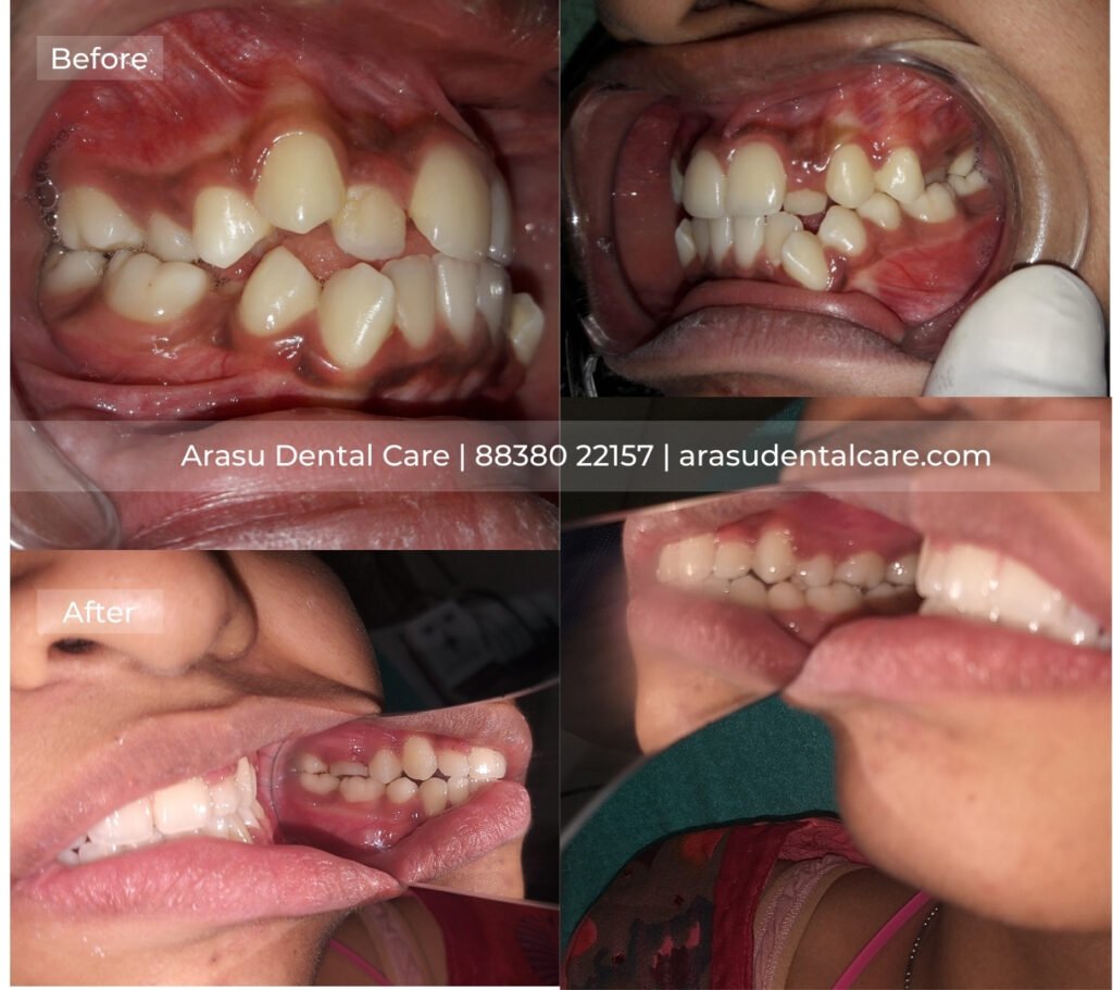 Before and after — forwardly placed teeth corrected, side profile view
