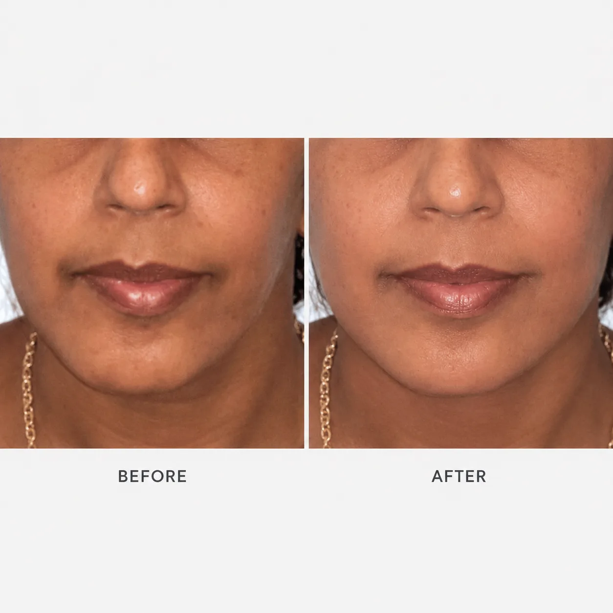 Before and after — Facial asymmetry corrected — Arasu Dental Care, Coimbatore