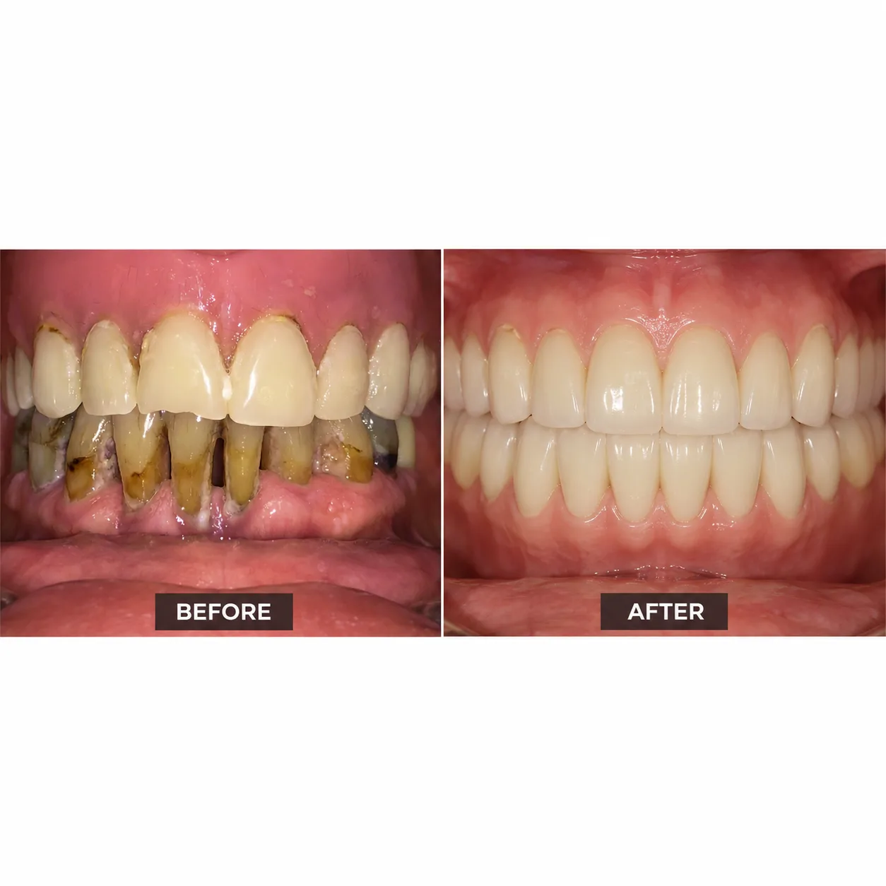Before and after — Full-arch All-on-4 — Arasu Dental Care, Coimbatore