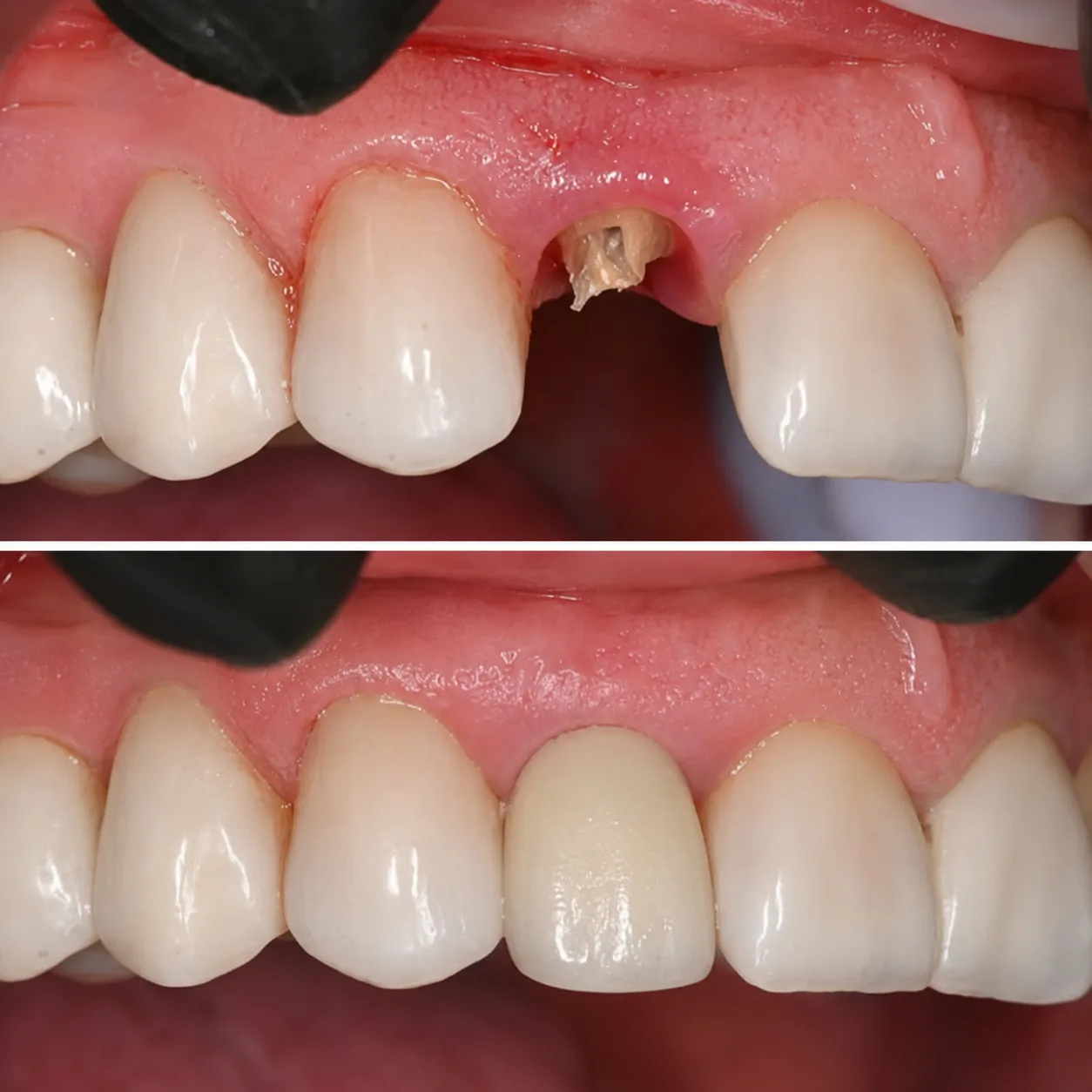 Before and after — Single tooth implant & crown — Arasu Dental Care, Coimbatore
