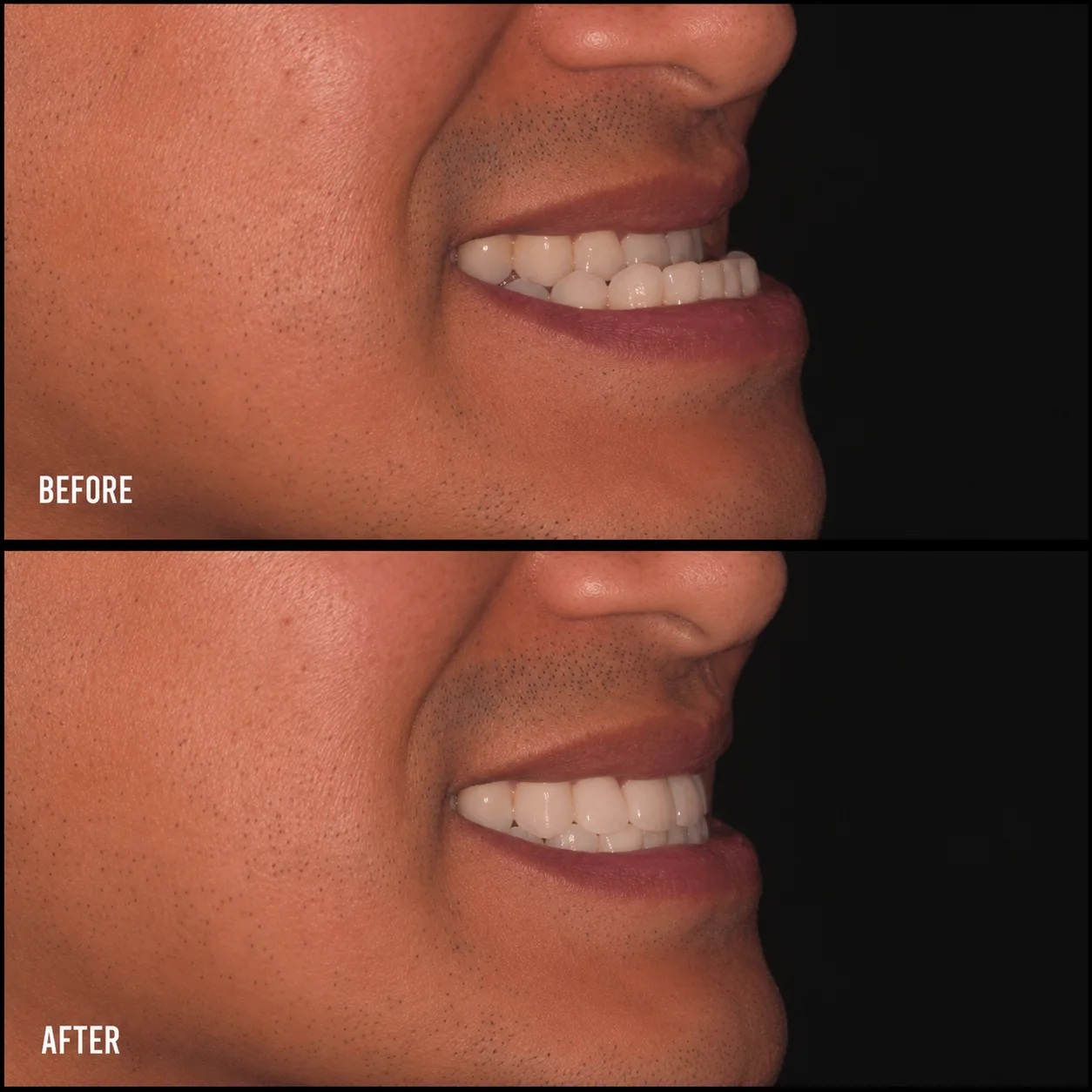 Before and after — Underbite corrected — Arasu Dental Care, Coimbatore