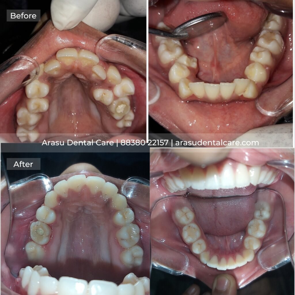 Before and after — upper and lower arch alignment