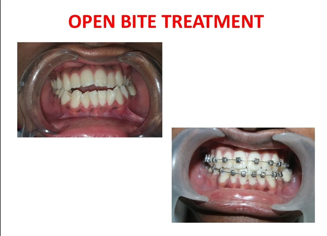Before and after — open bite treatment with braces