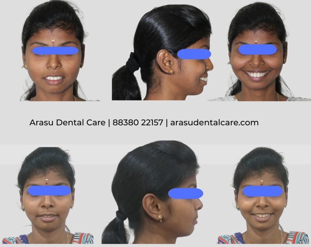 Before and after — a planned full smile makeover at Arasu Dental Care
