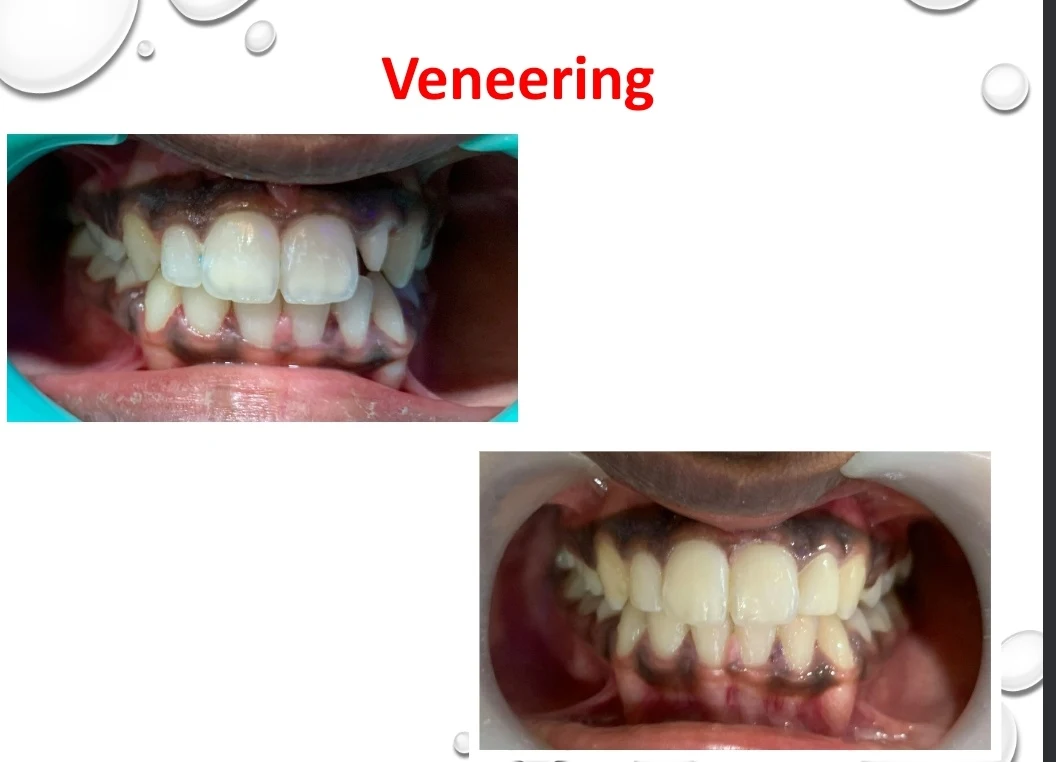 Before and after — front teeth reshaped and evened out with designed veneers