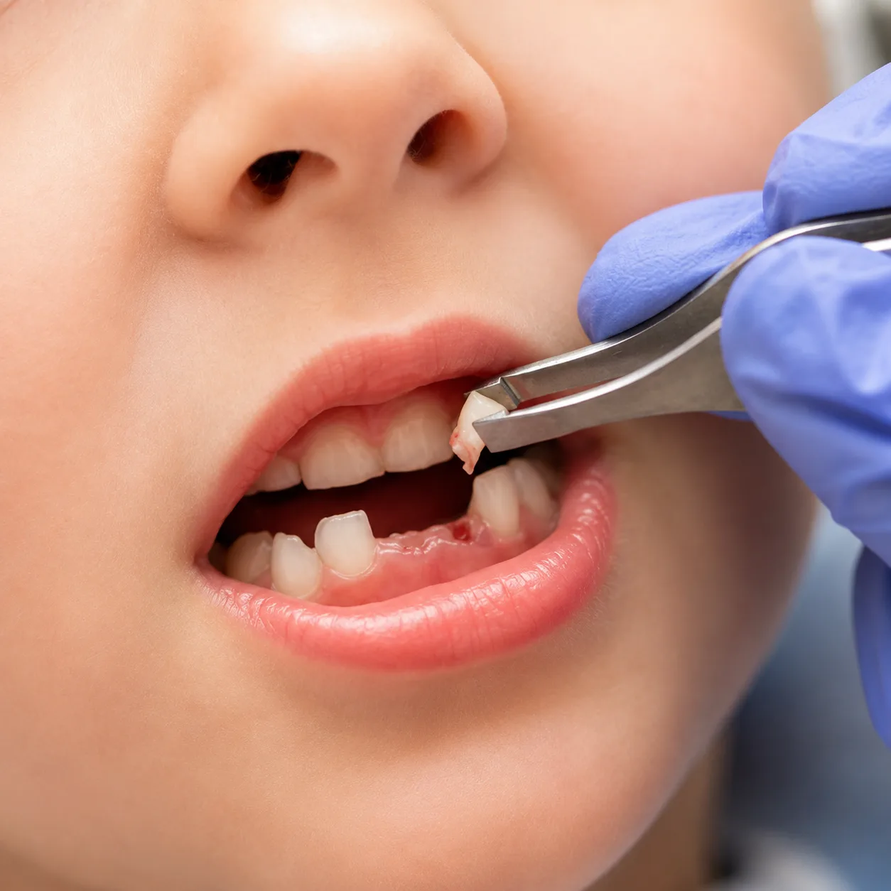 A pediatric dentist at Arasu Dental Care, Coimbatore, gently examining a young child's tooth in the dental chair