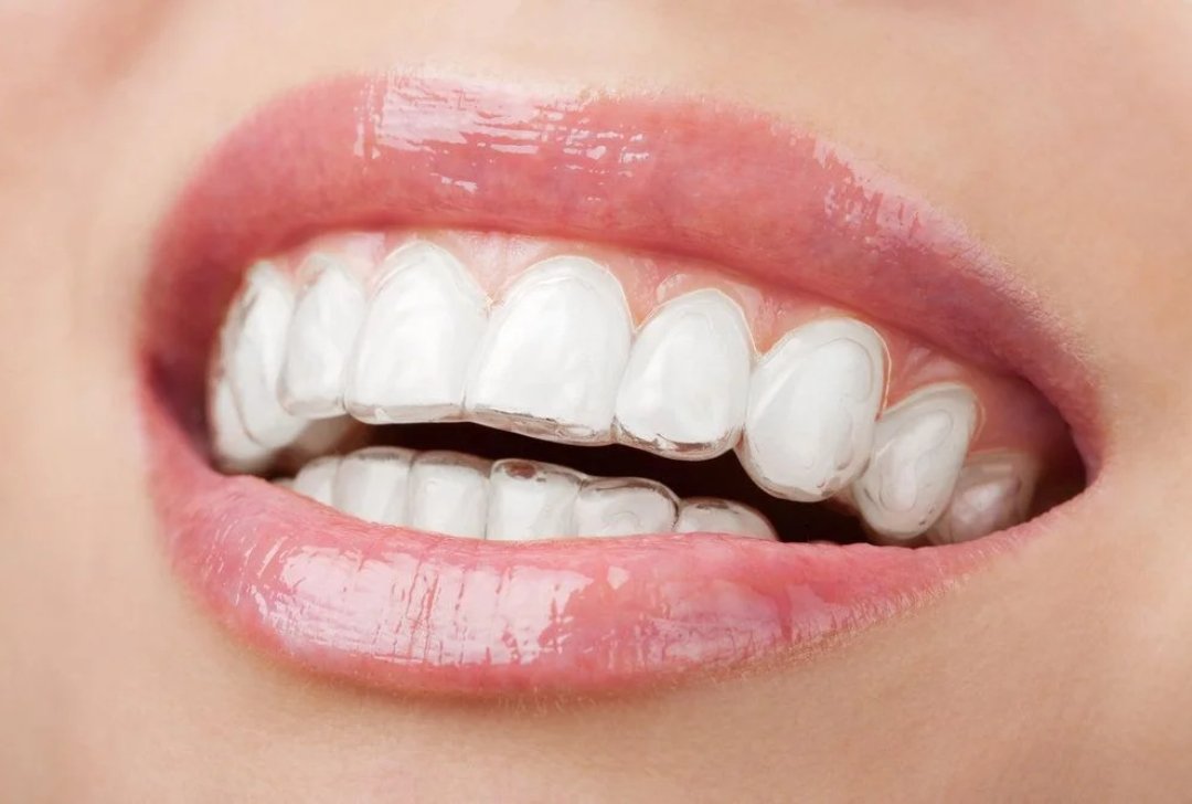 Close-up of a clear Invisalign aligner tray being fitted at Arasu Dental Care, Coimbatore