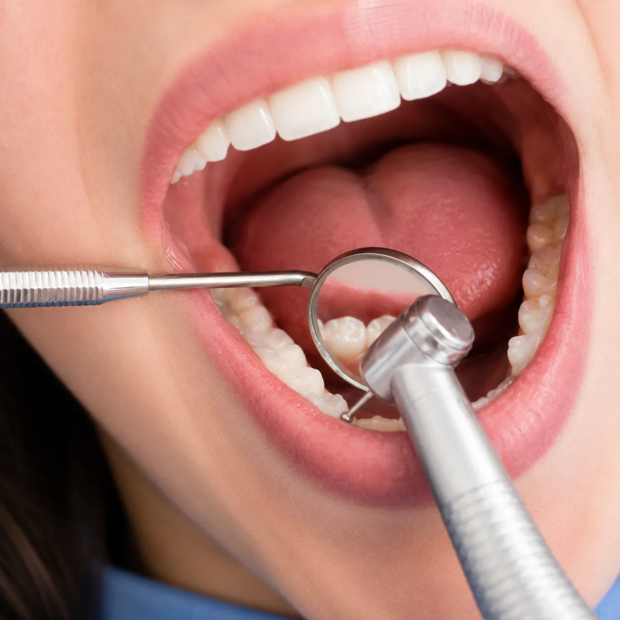 Dentist at Arasu Dental Care, Coimbatore, treating an infected tooth with root canal treatment to save it