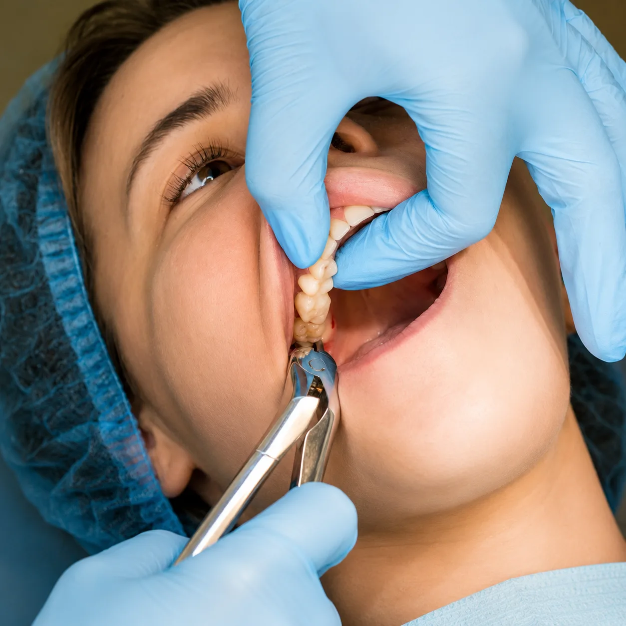 Dentist at Arasu Dental Care, Coimbatore, reviewing an X-ray to plan a comfortable wisdom tooth removal under local anaesthesia