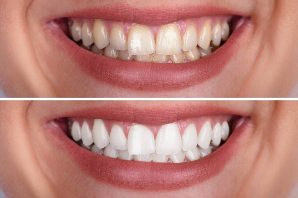 Teeth Whitening at Arasu Dental Care, Coimbatore