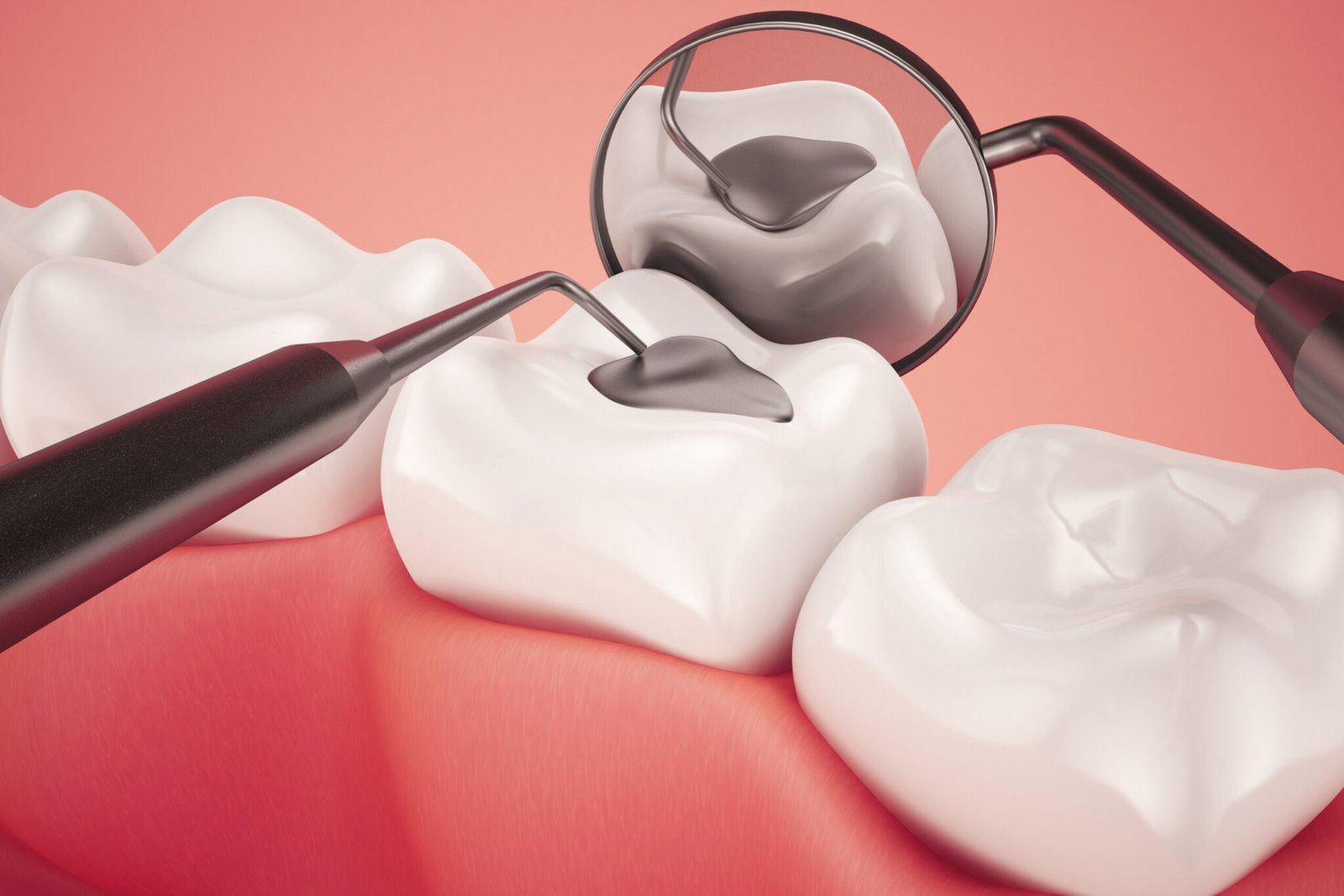 Dental Fillings at Arasu Dental Care, Coimbatore