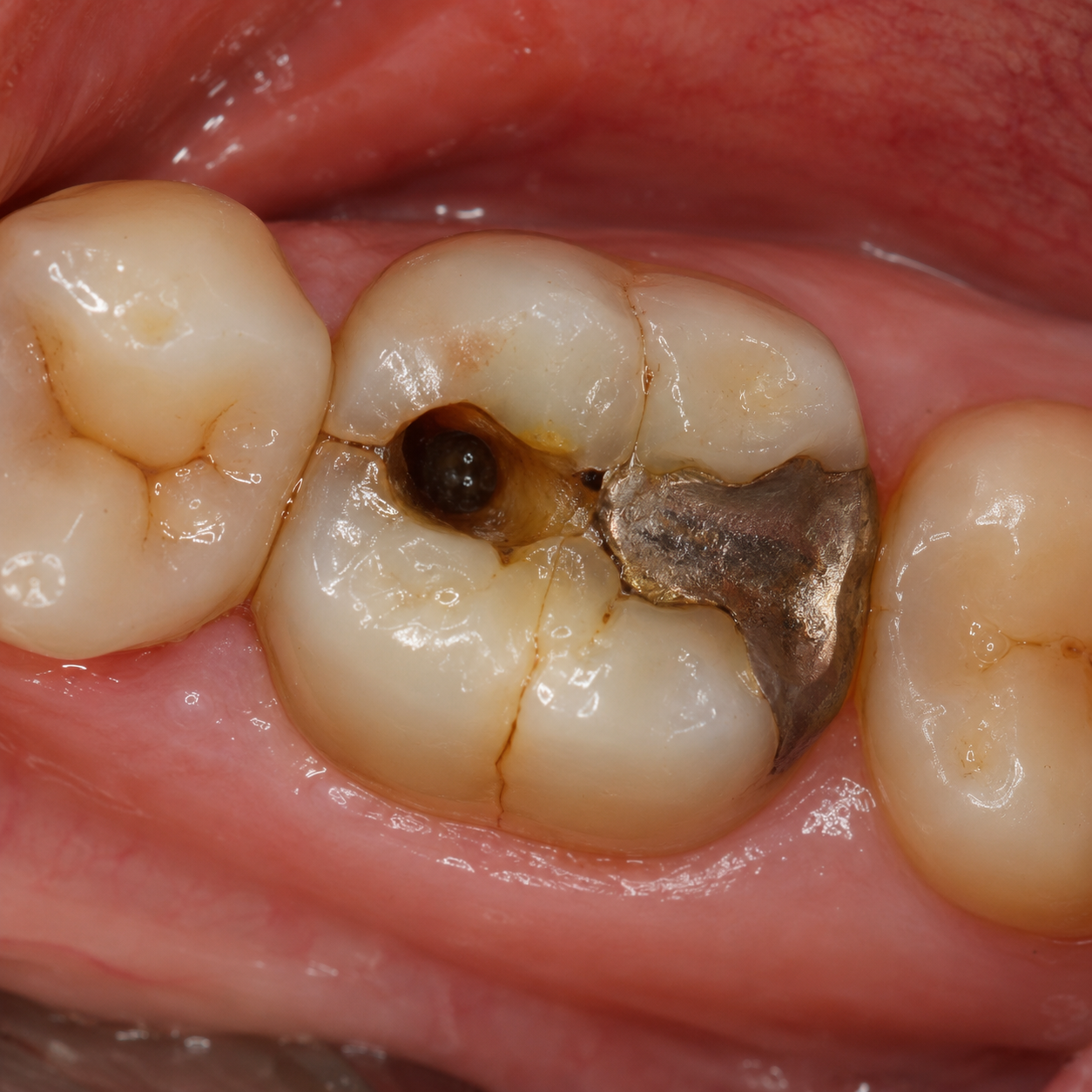 A cavity, crack, or old filling - Arasu Dental Care, Coimbatore