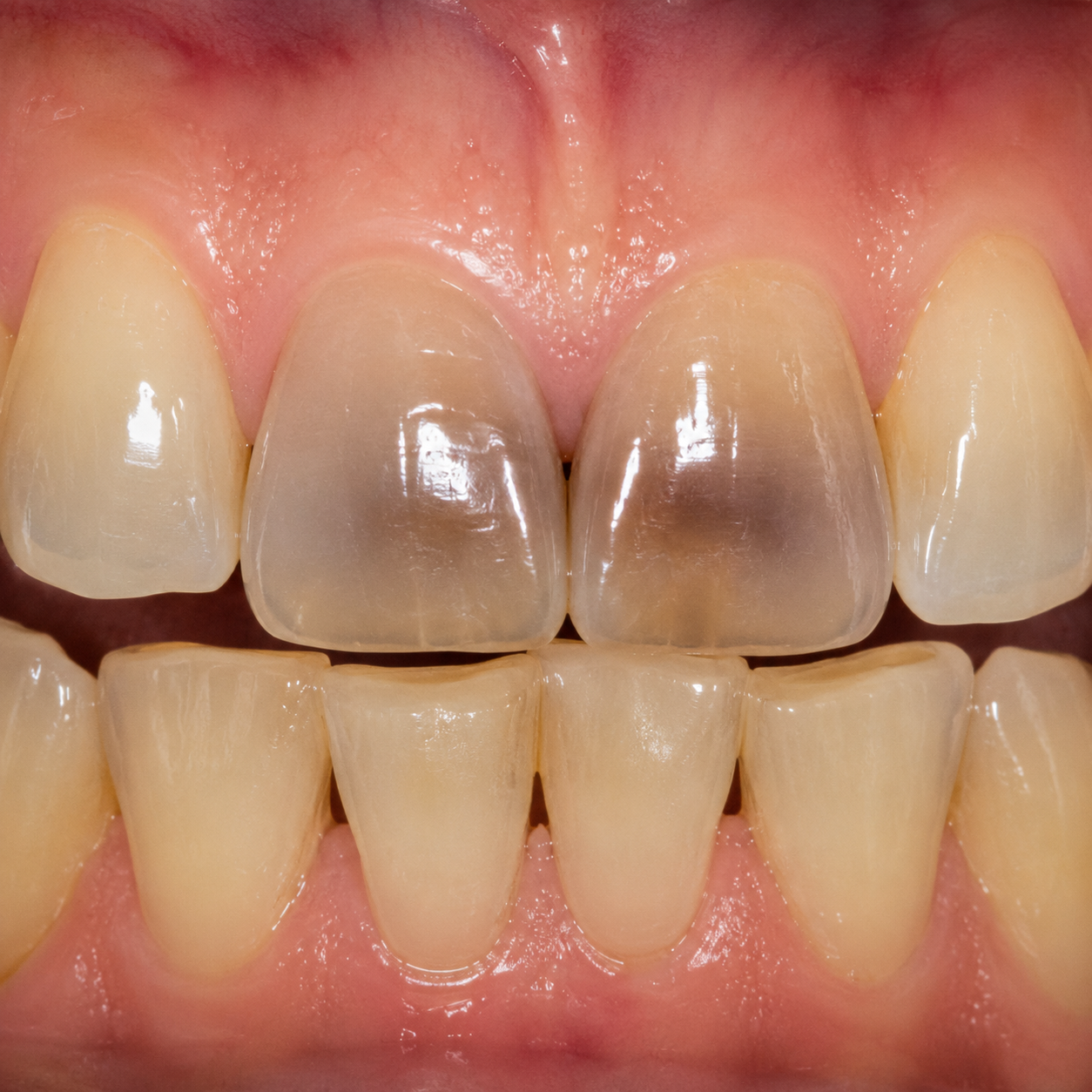 Internal stains - Arasu Dental Care, Coimbatore