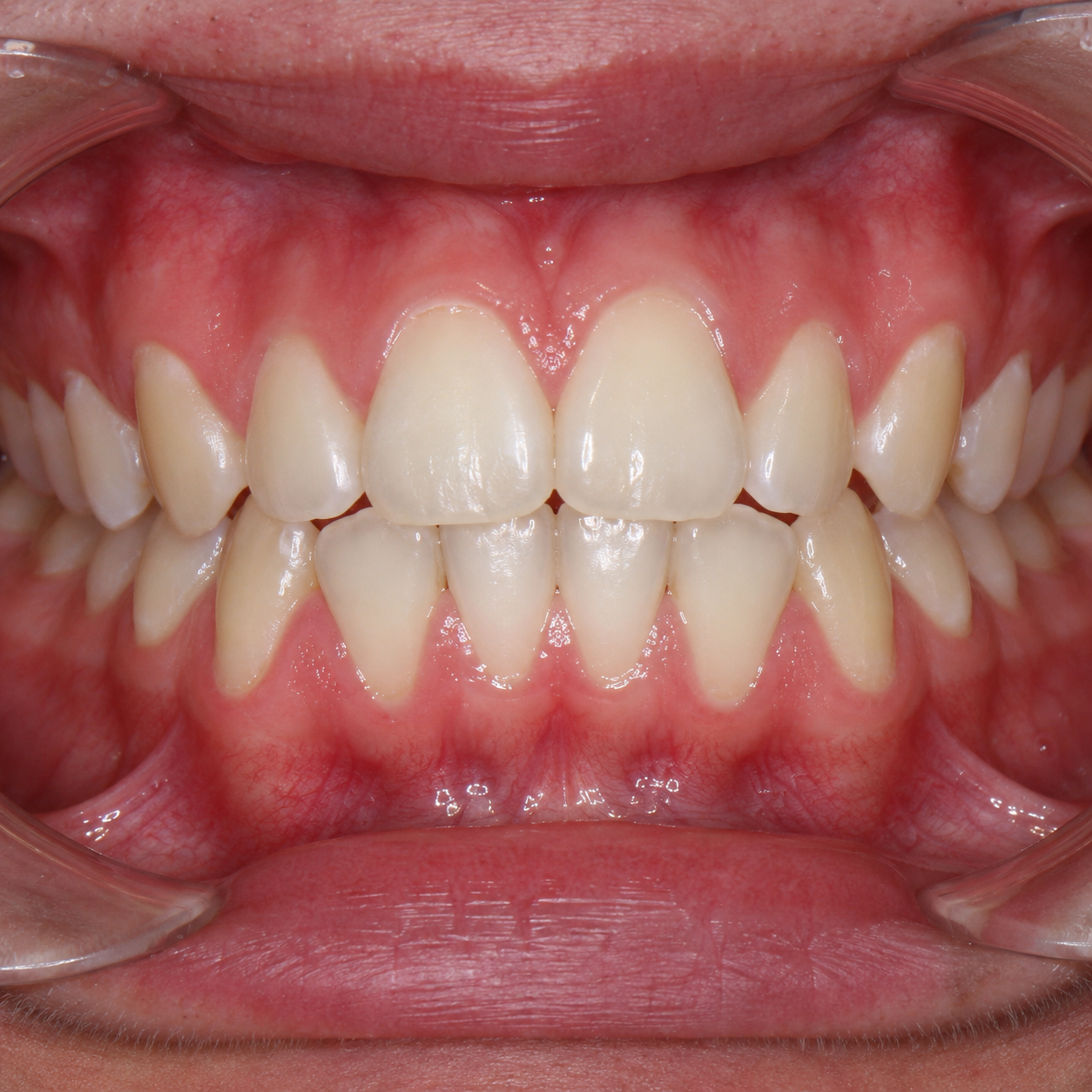 Mild crowding - Arasu Dental Care, Coimbatore