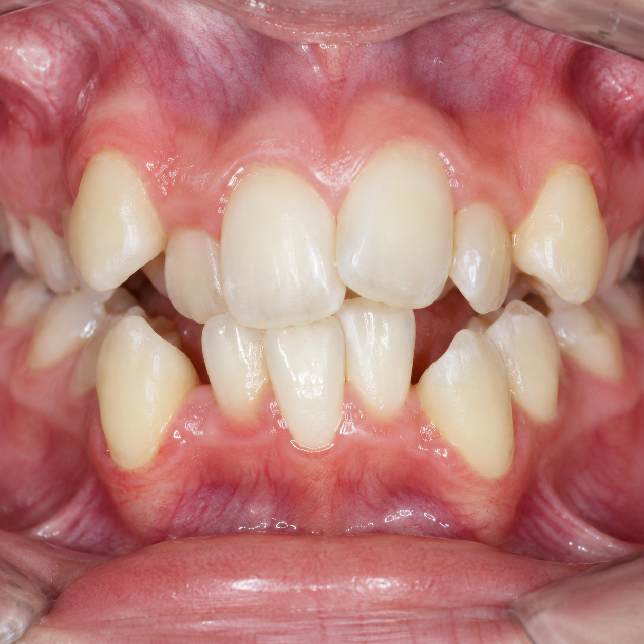 Severe crowding - Arasu Dental Care, Coimbatore