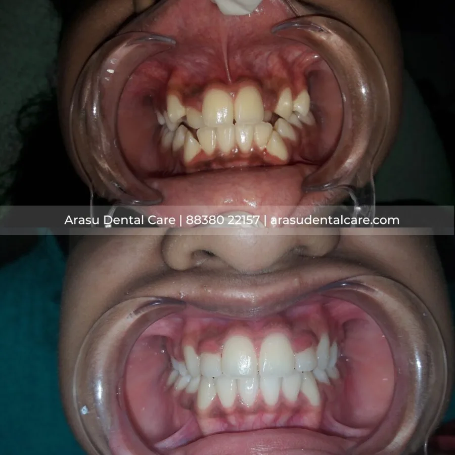 Before and after — crowded front teeth aligned with clear aligners at Arasu Dental Care, R.S. Puram, Coimbatore